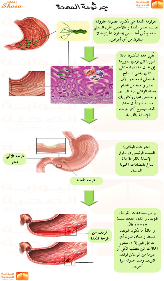 ما هو علاج جرثومة المعدة