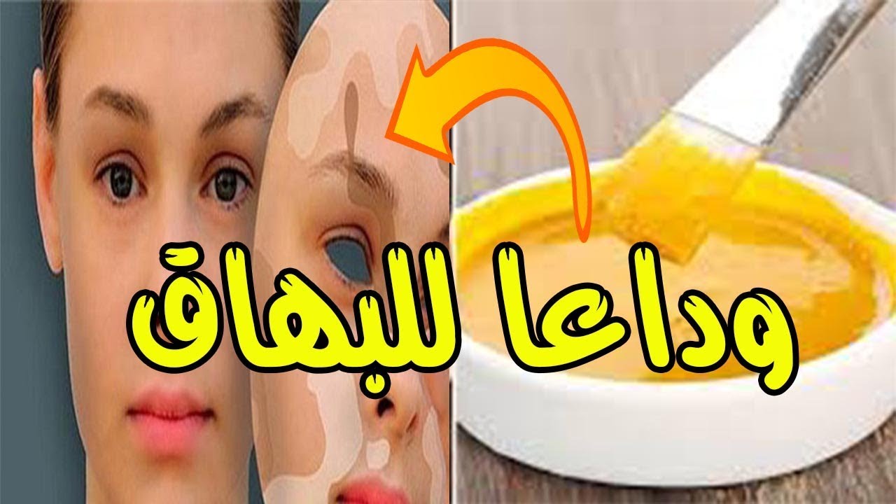 علاج البهاق في ساعة