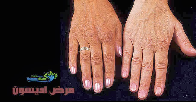 علاج مرض أديسون